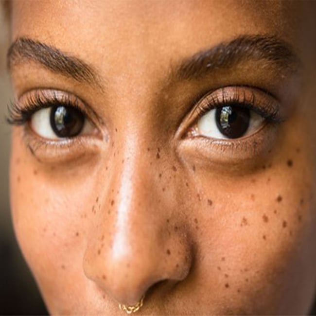 Are Black Skin Tone More Vulnerable To Hyperpigmentation