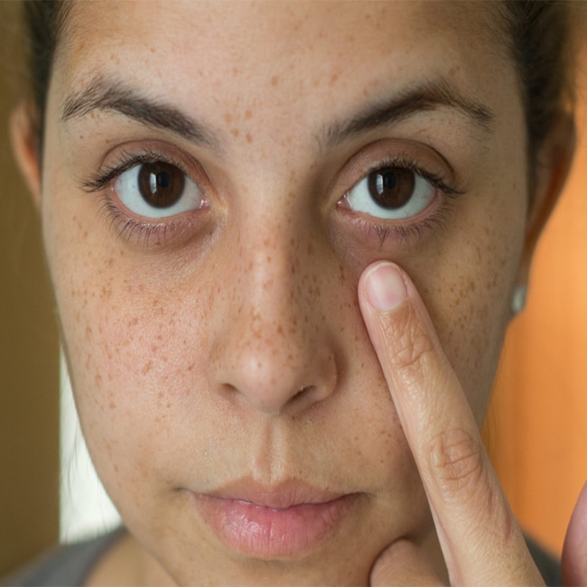 What Is Hyperpigmentation